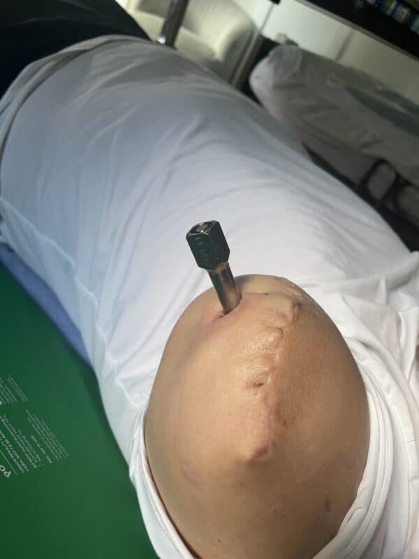 What’s New in Osseointegration